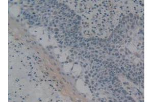 IHC-P analysis of Human Skin Cancer Tissue, with DAB staining. (HMGB1 antibody  (AA 9-163))