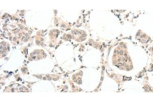 Immunohistochemistry of paraffin-embedded Human breast cancer tissue using TSPYL2 Polyclonal Antibody at dilution 1:30 (TSPY-Like 2 antibody)