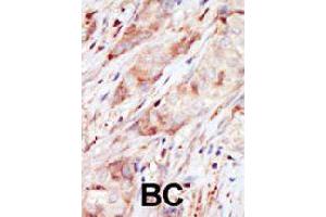Formalin-fixed and paraffin-embedded human cancer tissue reacted with GCK polyclonal antibody  , which was peroxidase-conjugated to the secondary antibody, followed by AEC staining. (GCK antibody  (C-Term))