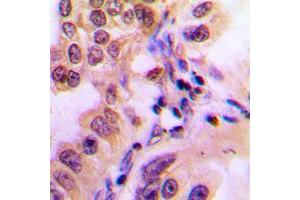 Immunohistochemical analysis of STAT2 (pY690) staining in human breast cancer formalin fixed paraffin embedded tissue section. (STAT2 antibody  (C-Term, pTyr690))