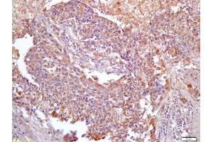 Formalin-fixed and paraffin embedded human lung carcinoma labeled with Anti-PER2/Period circadian protein 2 Polyclonal Antibody, Unconjugated (ABIN872716) at 1:200 followed by conjugation to the secondary antibody and DAB staining (ANKRD1 antibody  (AA 185-319))
