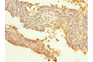 Immunohistochemistry of paraffin-embedded human cervical cancer using ABIN7174151 at dilution of 1:100 (SNRPB2 antibody  (AA 1-150))