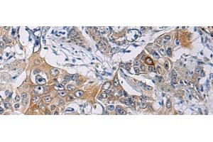 Immunohistochemistry of paraffin-embedded Human esophagus cancer tissue using KCNJ10 Polyclonal Antibody at dilution of 1:60(x200) (KCNJ10 antibody)