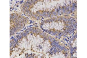 Immunohistochemistry of paraffin-embedded Human rectal cancer using TNFRSF1B Polyclonal Antibody at dilution of 1:200 (40x lens). (TNFRSF1B antibody)