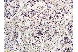 Formalin-fixed and paraffin-embedded human gastric carcinoma labeled with Rabbit Anti-IDE Polyclonal Antibody, Unconjugated (ABIN723680) at 1:300 followed by conjugation to the secondary antibody and DAB staining