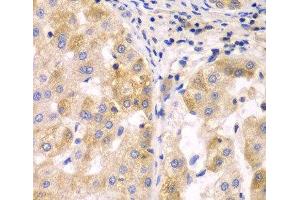 Immunohistochemistry of paraffin-embedded Human liver cancer using SULT2B1 Polyclonal Antibody at dilution of 1:100 (40x lens).