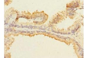 Immunohistochemistry of paraffin-embedded human prostate cancer using ABIN7160075 at dilution of 1:100 (MAP4K5 antibody  (AA 300-480))