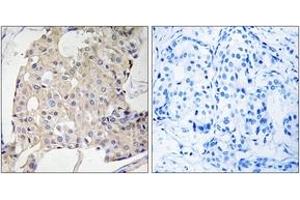 Immunohistochemistry analysis of paraffin-embedded human breast carcinoma tissue, using NDRG3 Antibody. (NDRG3 antibody  (AA 206-255))