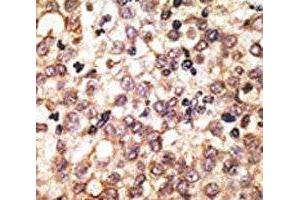 IHC analysis of FFPE human hepatocarcinoma tissue stained with the anti-TLR2 antibody (TLR2 antibody  (AA 720-749))