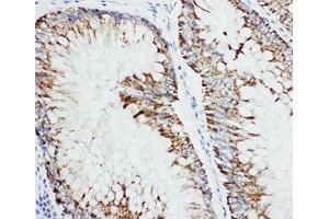 IHC-P: MAP3K1 antibody testing of human intestine cancer (MAP3K1 antibody  (C-Term))
