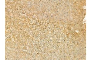 ABIN6263485 and ABIN6276746 at 1/100 staining human hepatocellular carcinoma by IHC-P.