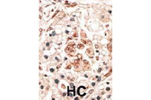 Formalin-fixed and paraffin-embedded human hepatocellular carcinoma tissue reacted with the HPCA polyclonal antibody  , which was peroxidase-conjugated to the secondary antibody, followed by DAB staining. (Hippocalcin antibody  (N-Term))