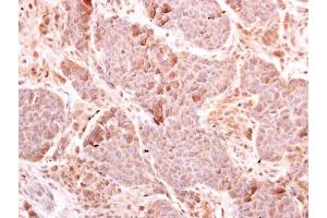 IHC-P Image MDA5 antibody [N2C1], Internal detects MDA5 protein at cytoplasm on human breast carcinoma by immunohistochemical analysis. (IFIH1 antibody)