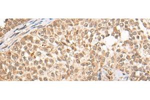 Immunohistochemistry of paraffin-embedded Human ovarian cancer tissue using CABIN1 Polyclonal Antibody at dilution of 1:50(x200) (CABIN1 antibody)