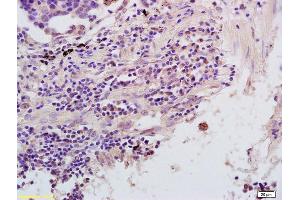 Formalin-fixed and paraffin embedded human lung carcinoma labeled with Rabbit Anti NFKBIE/IKB epsilon Polyclonal Antibody, Unconjugated (ABIN1386753) at 1:200 followed by conjugation to the secondary antibody and DAB staining