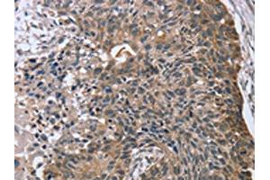 The image on the left is immunohistochemistry of paraffin-embedded Human esophagus cancer tissue using ABIN7130829(RASSF7 Antibody) at dilution 1/45, on the right is treated with fusion protein. (RASSF7 antibody)