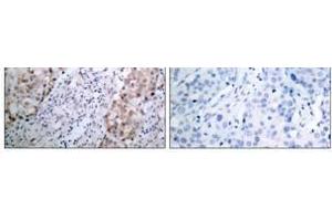 Immunohistochemical analysis of paraffin- embedded human breast carcinoma tissue using HER2 (phospho-Tyr1221/Tyr1222) antibody (E011076). (ErbB2/Her2 antibody  (pTyr1221, pTyr1222))