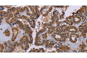 Immunohistochemistry of paraffin-embedded Human thyroid cancer tissue using GRK1 Polyclonal Antibody at dilution 1:40 (GRK1 antibody)