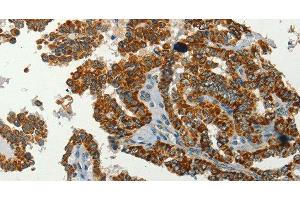 Immunohistochemistry of paraffin-embedded Human thyroid cancer using SERPINA9 Polyclonal Antibody at dilution of 1:60 (SERPINA9 antibody)