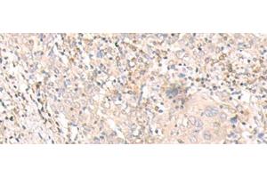 Immunohistochemistry of paraffin-embedded Human cervical cancer tissue using IL24 Polyclonal Antibody at dilution of 1:30(x200)