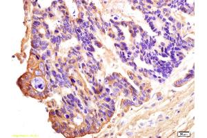 Formalin-fixed and paraffin embedded human rectal carcinoma labeled with Anti-DDX43/CT13 Polyclonal Antibody, Unconjugated (ABIN716021) at 1:200 followed by conjugation to the secondary antibody and DAB staining.