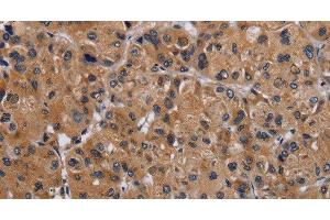 Immunohistochemistry of paraffin-embedded Human liver cancer using GNAS Polyclonal Antibody at dilution of 1:30 (GNAS antibody)