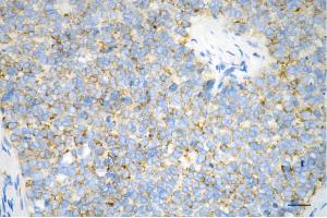 Immunohistochemistry was performed on paraffin-embedded human breast carcinoma using hexokinase 1 antibody (ABIN7798906), 1:200). (Recombinant Hexokinase 1 antibody)