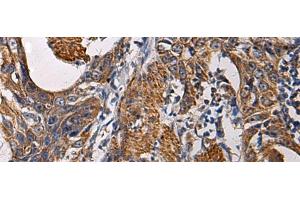 Immunohistochemistry of paraffin-embedded Human esophagus cancer tissue using SSH3 Polyclonal Antibody at dilution of 1:60(x200) (SSH3 antibody)