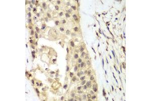 Immunohistochemistry of paraffin-embedded human lung cancer using FGFR1 antibody at dilution of 1:100 (400x lens). (FGFR1 antibody)