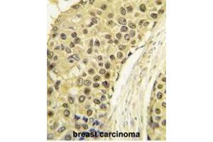 Formalin-fixed and paraffin-embedded human breast carcinoma tissue reacted with CCNA2 antibody (C-term) (ABIN391455 and ABIN2841432) , which was peroxidase-conjugated to the secondary antibody, followed by DAB staining. (Cyclin A antibody  (C-Term))