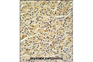 HOXA3 Antibody IHC analysis in formalin fixed and paraffin embedded prostate carcinoma followed by peroxidase conjugation of the secondary antibody and DAB staining. (HOXA3 antibody  (C-Term))