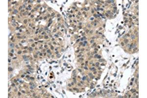 The image on the left is immunohistochemistry of paraffin-embedded Human breast cancer tissue using ABIN7192310(SENP6 Antibody) at dilution 1/20, on the right is treated with synthetic peptide. (SENP6 antibody)