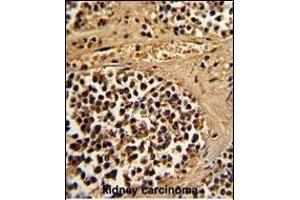 Formalin-fixed and paraffin-embedded human kidney carcinoma reacted with ESRRA Antibody (Center), which was peroxidase-conjugated to the secondary antibody, followed by DAB staining. (ESRRA antibody  (AA 131-159))