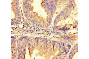 Immunohistochemistry of paraffin-embedded human endometrial cancer using ABIN7165645 at dilution of 1:100 (IMPACT antibody  (AA 41-320))