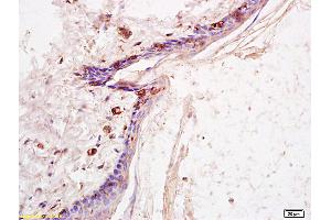 Immunohistochemistry (IHC) image for anti-EGFR vIII (EGFRv3) (AA 1-50) antibody (ABIN742035) (EGFRviii antibody  (AA 1-50))