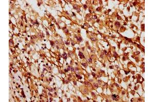 IHC image of ABIN7160617 diluted at 1:400 and staining in paraffin-embedded human melanoma performed on a Leica BondTM system. (MYO3B antibody  (AA 1110-1276))