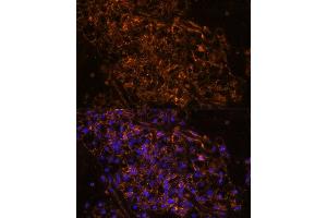 Immunofluorescence analysis of human kidney cancer using SCNN1G antibody (ABIN7270387) at dilution of 1:100. (SCNN1G antibody  (AA 100-250))