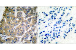 Peptide - +Immunohistochemical analysis of paraffin-embedded human breast carcinoma tissue using Cox2 antibody. (COX2 antibody)