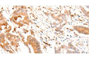 Immunohistochemistry of paraffin-embedded Human colon cancer tissue using ABCA4 Polyclonal Antibody at dilution of 1:30 (ABCA4 antibody)
