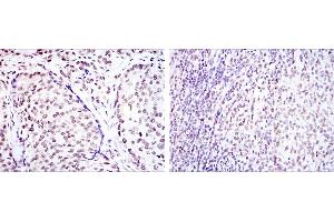 Immunohistochemical analysis of paraffin-embedded prostate cancer tissues (left) and submaxillary tumor tissues (right) using CREB1 mouse mAb with DAB staining. (CREB1 antibody)