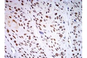 Immunohistochemical analysis of paraffin-embedded esophageal cancer tissues using KDM1A mouse mAb with DAB staining. (LSD1 antibody  (AA 55-263))