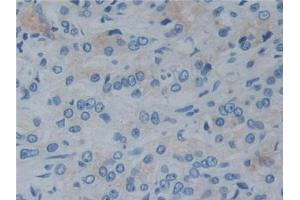 IHC-P analysis of Human Prostate cancer Tissue, with DAB staining. (Reelin antibody  (AA 2398-2608))