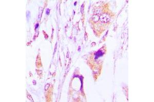 Immunohistochemical analysis of IgG1 staining in human lung cancer formalin fixed paraffin embedded tissue section. (Rabbit anti-Human IgG1 (Center) Antibody)