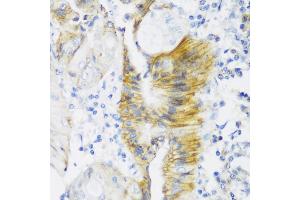Immunohistochemistry of paraffin-embedded human colon carcinoma using CLDN4 antibody (ABIN6133648, ABIN6138690, ABIN6138691 and ABIN6216719) at dilution of 1:150 (40x lens). (Claudin 4 antibody  (C-Term))