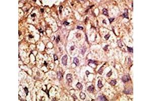 IHC analysis of FFPE human hepatocarcinoma tissue stained with the ACE2 antibody (ACE2 antibody  (AA 59-90))