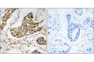 Immunohistochemistry analysis of paraffin-embedded human breast carcinoma tissue, using RTCD1 Antibody.