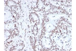 Formalin-fixed, paraffin-embedded human prostate carcinoma stained with NRF1 Mouse Monoclonal Antibody (NRF1/2609). (NFE2L1 antibody)