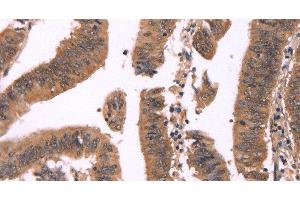 Immunohistochemistry of paraffin-embedded Human colon cancer tissue using FBXO31 Polyclonal Antibody at dilution 1:40 (FBXO31 antibody)