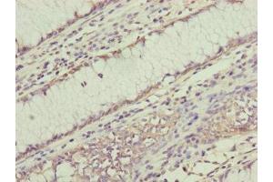 Immunohistochemistry of paraffin-embedded human colon cancer using ABIN7168238 at dilution of 1:100 (RNF11 antibody  (AA 1-154))