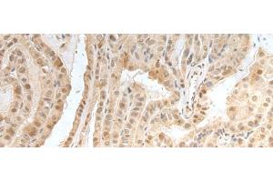 Immunohistochemistry of paraffin-embedded Human thyroid cancer tissue using ZNF24 Polyclonal Antibody at dilution of 1:35(x200) (ZNF24 antibody)